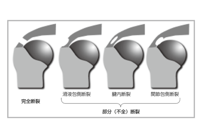 腱板断裂について - いとうペインクリニックブログ