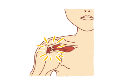 腱板断裂についてのアイキャッチ画像