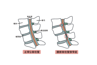 腰部脊柱管狭窄症②　腰部脊柱管狭窄症は手術しなくてもよくなるのか？のアイキャッチ画像