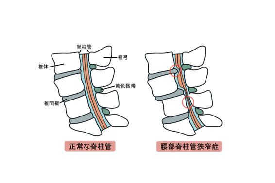 腰部脊柱管狭窄症⓹　手術後の腰背部痛（FBSS：Failed back surgery syndrome）について