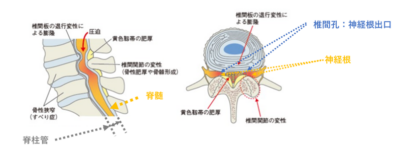 腰部脊柱管狭窄症①　診断についてのアイキャッチ画像