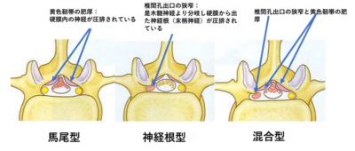 腰部脊柱管狭窄症③　保存療法　薬物・ブロック注射についてのアイキャッチ画像
