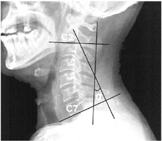 大多数の線維筋痛症患者は、ストレートネック？