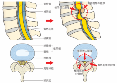 腰痛症　腰部脊柱管狭窄症の主要な原因の1つである黄色靭帯の肥厚についてのアイキャッチ画像