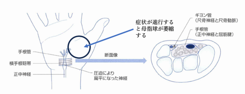 手指のしびれ痛み