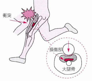 打撲傷と肉離れについてのアイキャッチ画像