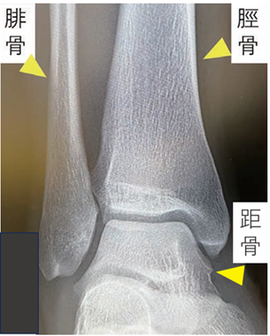 足のねん挫について