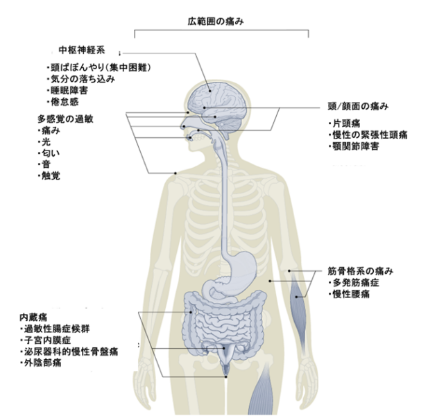 痛覚変調性疼痛（nociplastic pain）とは