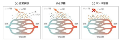 リンパの流れと用手的リンパドレナージ(MLD)についてのアイキャッチ画像