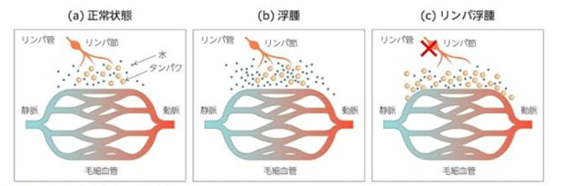 リンパの流れと用手的リンパドレナージ（MLD）について