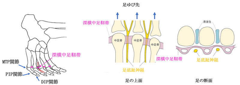 モートン病・・足の痛み
