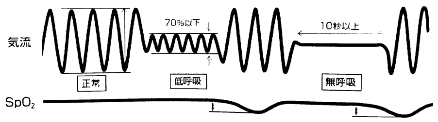 低呼吸（Hypopnea）