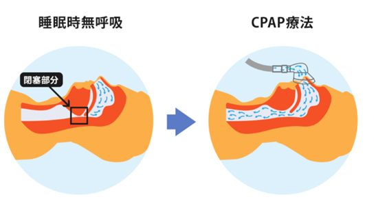 SASの治療　CPAP （Continuous Positive Airway Pressure）について
